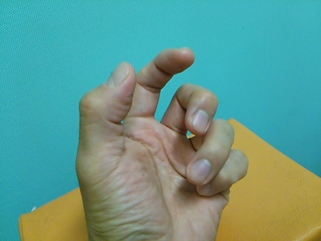 練馬区で手 指の痛み Tfcc損傷 母指ｃｍ関節症の治療なら江古田の整骨院 手塚接骨院 練馬区